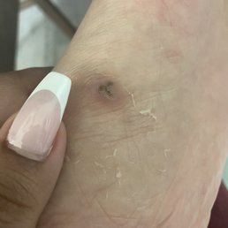 1 week and 6 days of healing from a pedi cure scrub