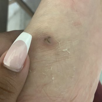 Palatial Nail Lounge - 1 week and 6 days of healing from a pedi cure scrub - Nail Salons Near Me - Beverly Hills, California
