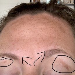 Uneven eyebrows. Sores on eyelids where skin was removed. Uneven eyebrows. Sores on eyelids where skin was removed.