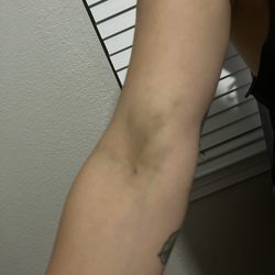 Octapharma Plasma - Bruising at the donation site.
