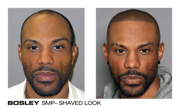 Bosley Hair Transplant Restoration 47 Photos Hair Loss