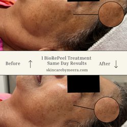 Skin Care by Meera - 1 BioRePeel Treatment Before & After