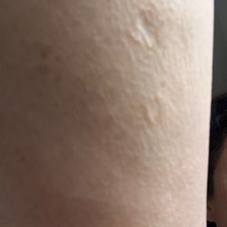Bend Dermatology Clinic - Pitted, crepey skin and left atrophic scarring.