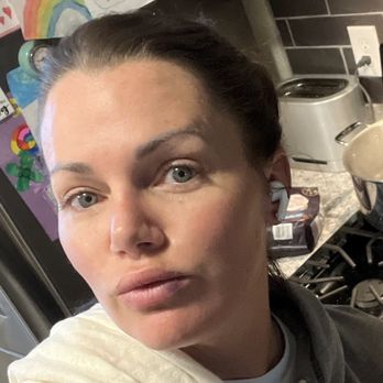 James Lowe, MD - My new beautiful lips and smoothing forehead. All by Dr. Lowe - Cosmetic Surgeons Near Me - Oklahoma City, Oklahoma