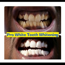 Prowhite Teeth Whitening - Before and after teeth whitening sessions.