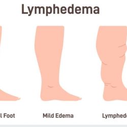 Amanda Queen Massage & Wellness - Certified in manual drainage , wound care, and wrapping for all your lymphedema and lymphatic needs.
