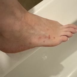 This is the bumps that came out on my foot that Saturday night this is nasty you guys need to be way more clean this is not good