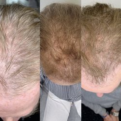 Style International Medical Skincare and Laser - Hair treatment to improve hair growth. Microneedling used to stimulate hair growth with a serum.