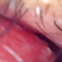 Brian Schwab, MD - Narrow nasal valve AFTER surgeries