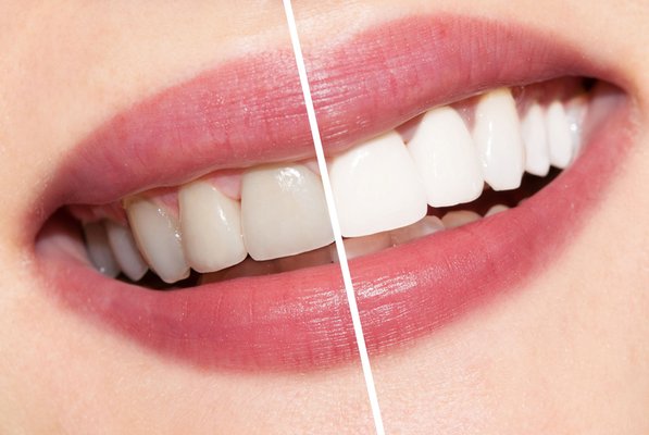Veneers - New smile changes your life! No-prep, no-shot veneers transform your smile. Veneers - New smile changes your life! No-prep, no-shot veneers transform your smile.