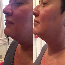 Red Carpet On Queen - Face with endermolift to remove double chin