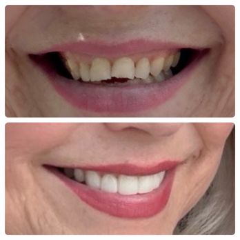 Bastrop Modern Dentistry - Loss of enamel caused chipping and discoloration. Before/After - General Dentistry Near Me - Bastrop, Texas Bastrop Modern Dentistry - Loss of enamel caused chipping and discoloration. Before/After - General Dentistry Near Me - Bastrop, Texas