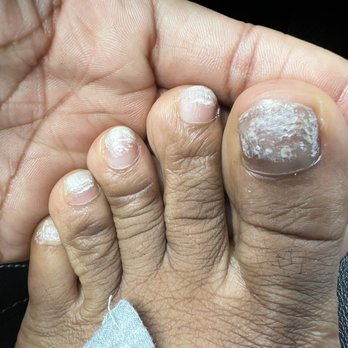 Nail First - Fungus - Nail Salons Near Me - Atlanta, Georgia