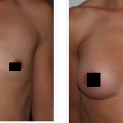 Iconic Plastic Surgery - Breast Augmentation