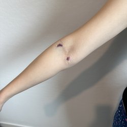 Desert West Obstetrics & Gynecology - 2 bruises caused by Liz.