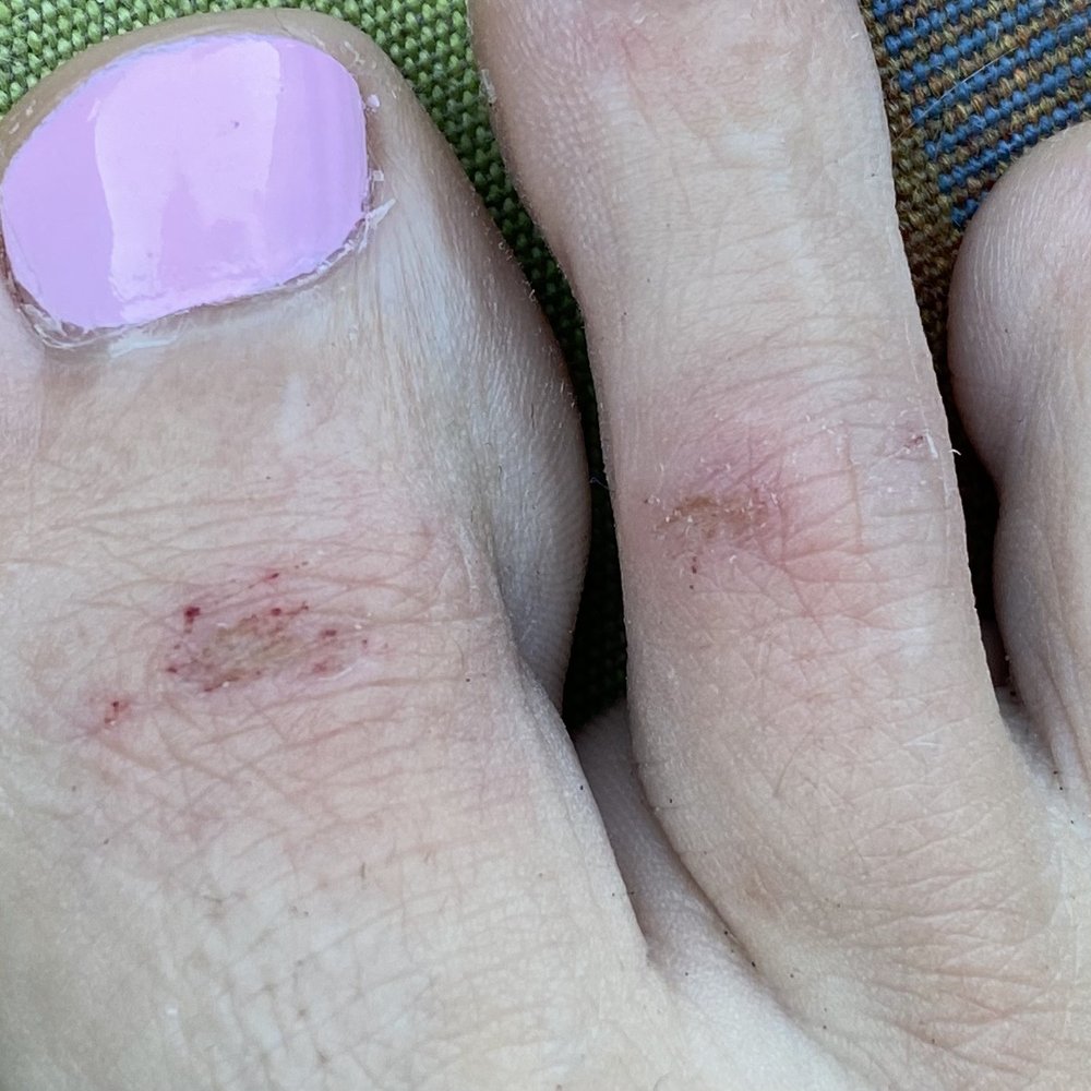 Aptos Nails - My toes the next day after a pedicure. She scrubbed the top of my toes so hard it broke the skin! - Nail Salons Near Me - Aptos, California