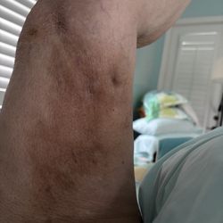 Vein Specialists - Gross skin discoloration