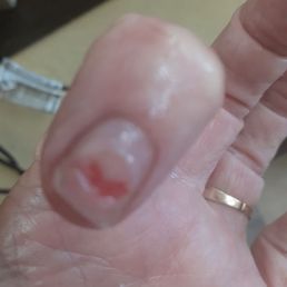 Painful acrylic nail removal!!!