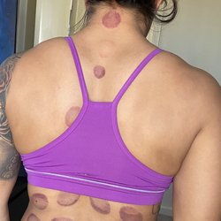 Nikki's Massage Spa - Cupping with deep tissue massage