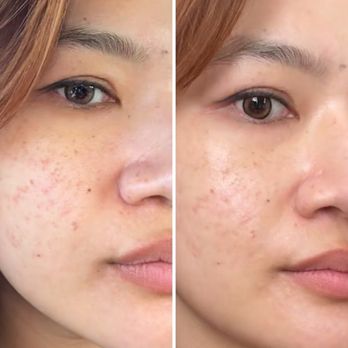 Akari Medspa - before + after 1 session of microneedling and rejuran - Medical Spas Near Me - Newport Beach, California Akari Medspa - before + after 1 session of microneedling and rejuran - Medical Spas Near Me - Newport Beach, California