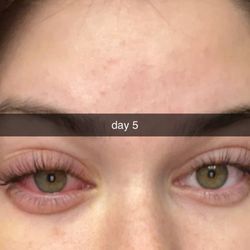 The Beauty Society - Day 5 burn