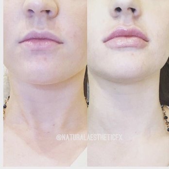 OSVI Dermatology - Lip injections - Dermatologists Near Me - Torrance, California OSVI Dermatology - Lip injections - Dermatologists Near Me - Torrance, California