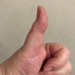 Steve Aziz, Rheumatologist - My happy thumb