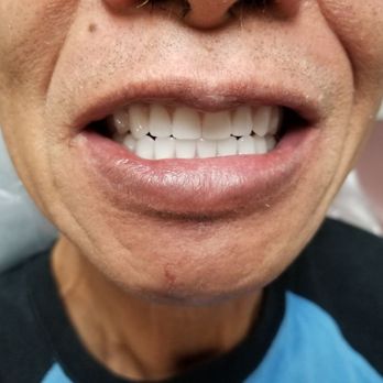 Excel Dental & Dentures - Prosthodontists Near Me - Lynnwood, Washington Excel Dental & Dentures - Prosthodontists Near Me - Lynnwood, Washington