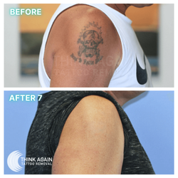 Think Again Tattoo Removal
