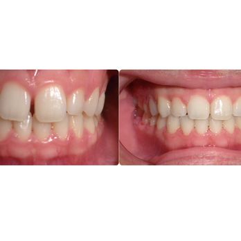 Bock Orthodontics - Before and after - Orthodontists Near Me - Redlands, California Bock Orthodontics - Before and after - Orthodontists Near Me - Redlands, California