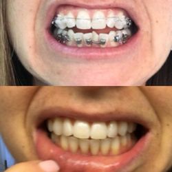 Michelle Allar Orthodontics - Braces on 4/4/16, jaw joint replacement 11/2/16, braces off 5/17/17!