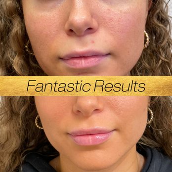 Lumera Regenerative Medicine - Lip filler treatment before and after results. - Medical Spas Near Me - Tualatin, Oregon Lumera Regenerative Medicine - Lip filler treatment before and after results. - Medical Spas Near Me - Tualatin, Oregon