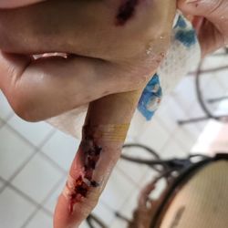 Premier ER & Urgent Care - Woodway - 3 days after superficial stitches. My finger is damaged forever