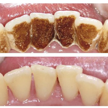 KF Dental - Stain Removal - Cosmetic Dentists Near Me - Edinburgh, EDH KF Dental - Stain Removal - Cosmetic Dentists Near Me - Edinburgh, EDH