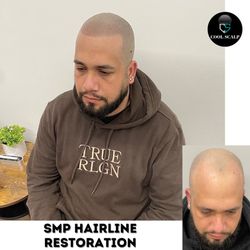 Cool Scalp - Complete Hairline restoration