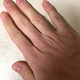 My thumb and my pinky got the worse of it.