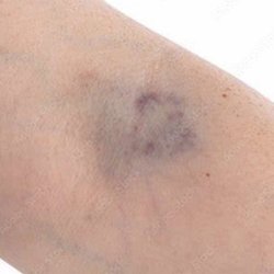 Biolife Plasma - Hematoma and arm after being on the machine for three minutes or less!