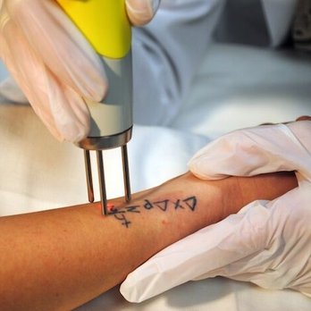 Evanesce Laser Tattoo Removal - The Astanza Duality in action - Tattoo Removal Near Me - Seminole, Florida Evanesce Laser Tattoo Removal - The Astanza Duality in action - Tattoo Removal Near Me - Seminole, Florida