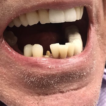 Nuova Dental Office - Two weeks later, the second cracked off tooth - General Dentistry Near Me - Sacramento, California