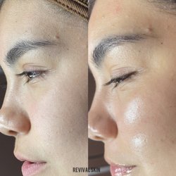 Dermplaning before and right after