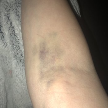 Bluterguss nach blutabnahme