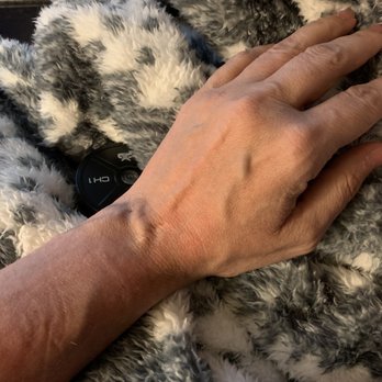 Benjamin P Amis, MD - Swollen veins feel like liquid fire is coursing thru them. - Orthopedists Near Me - Austin, Texas