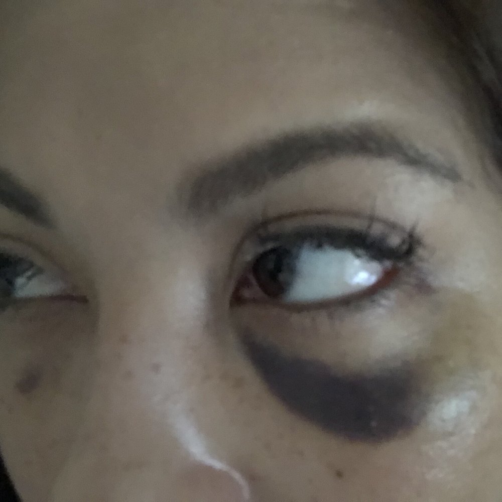 Sovous - 4 days after tear through - Cosmetic Surgeons Near Me - New York, New York Sovous - 4 days after tear through - Cosmetic Surgeons Near Me - New York, New York
