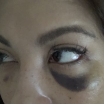 Sovous - 4 days after tear through - Cosmetic Surgeons Near Me - New York, New York