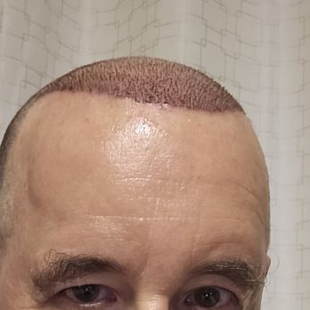 TJ Hair System - 1 week - Hair Loss Centers Near Me - Tijuana, BCN TJ Hair System - 1 week - Hair Loss Centers Near Me - Tijuana, BCN