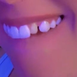 Missing veneer