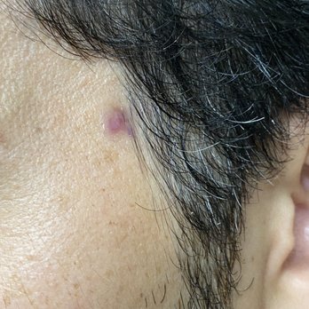 Boardroom Salon for Men - Allen - More than two months and not healed probably due to leaving hair in wound - Barbers Near Me - Allen, Texas