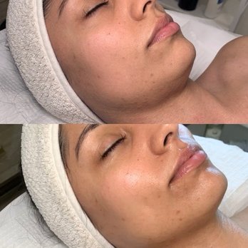JT Aesthetic - (Top) before my facial (bottom) nice and hydrated after facial - Tattoo Removal Near Me - Eastvale, California JT Aesthetic - (Top) before my facial (bottom) nice and hydrated after facial - Tattoo Removal Near Me - Eastvale, California