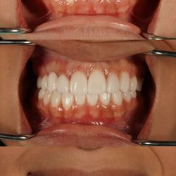Paradise Valley Dental - If you were a victim from getting composite bonding by an unlicensed professional, lets see if we can help save your smile!