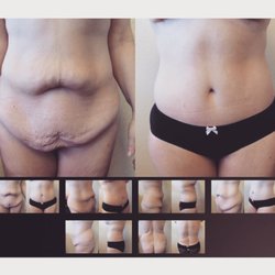 Jennifer Boll, MD - Body Lift by Dr. Boll